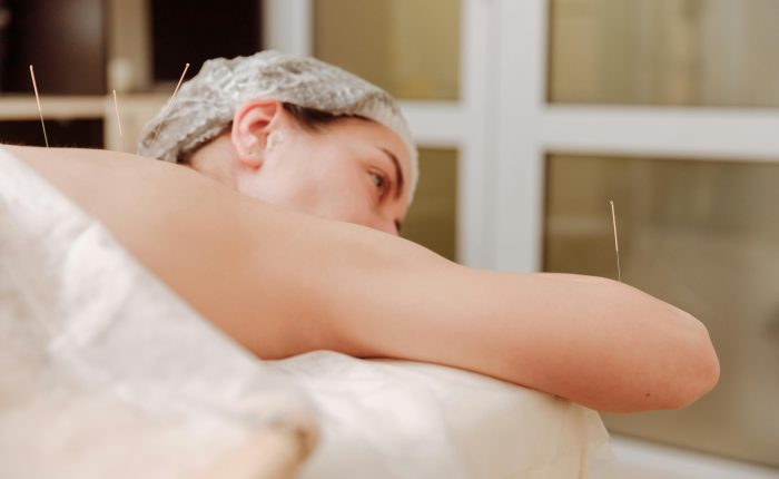 Close-up of acupuncture therapy, traditional Chinese wellness