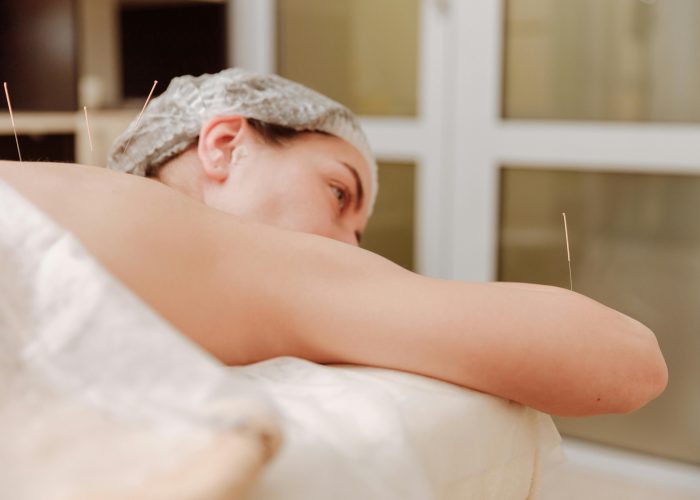 Close-up of acupuncture therapy, traditional Chinese wellness